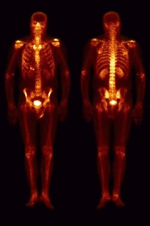Whole Body Bonescan